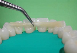 шинирование подвижных зубов